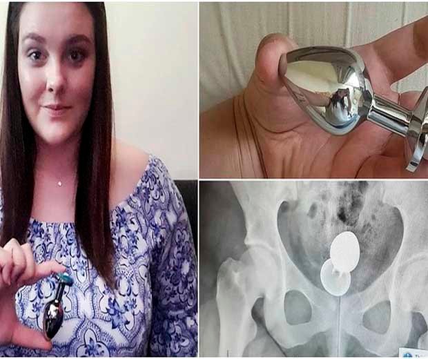 Jovem quase teve intestino perfurado por usar plug anal