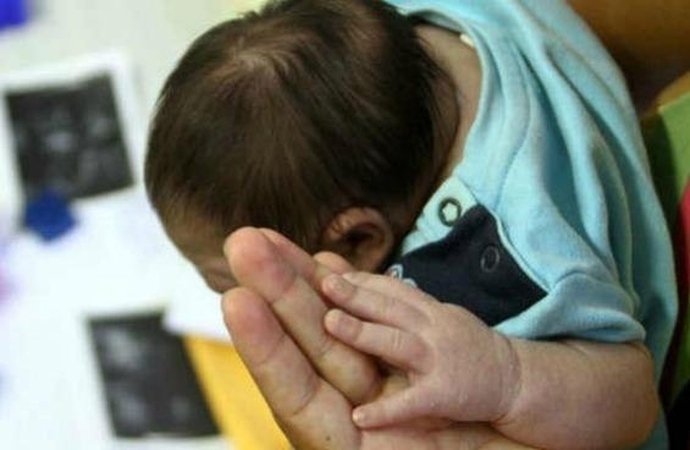 Saúde incorpora novo medicamento para pacientes com Microcefalia