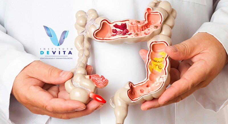Câncer colorretal tem 90% de chance de cura se descoberto no início