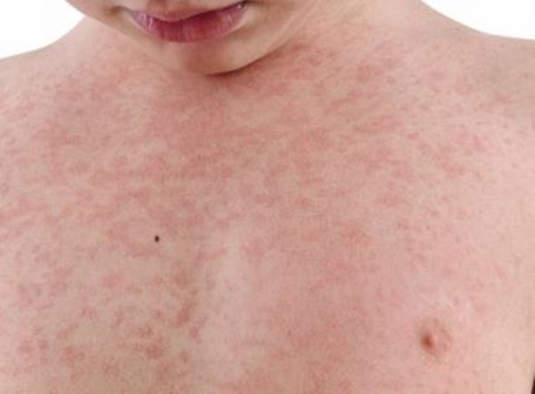 Brasil corre risco de perder certificado de eliminação do sarampo, diz Opas