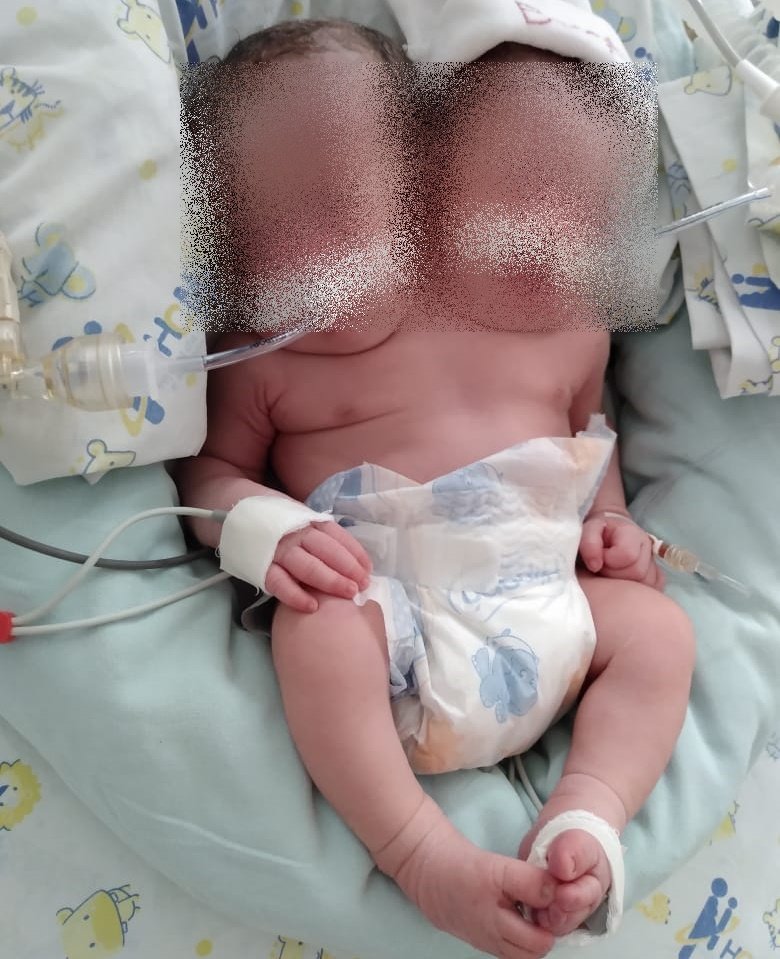 Bebê com duas cabeças nasce no interior de São Paulo