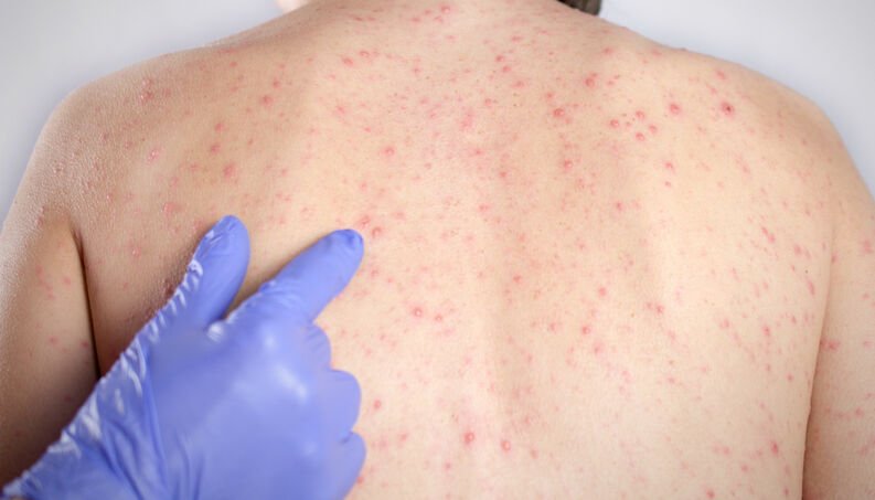 Confira três dúvidas sobre a vacinação contra o sarampo