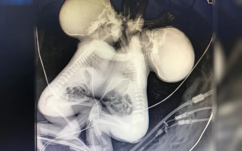 Gêmeas siamesas nascem unidas pelo tórax e com corações ‘colados’, em Goiânia