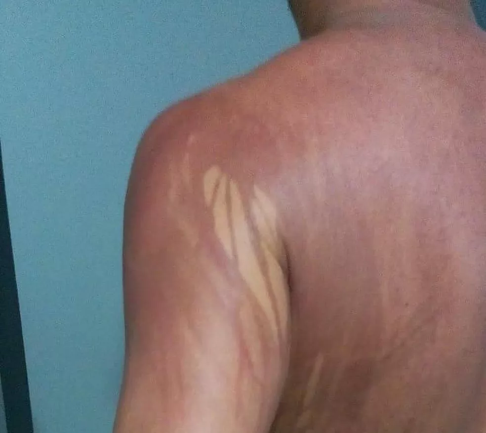 Turista de MG que teve manchas no corpo após banho de mar na Bahia é internado em hospital de Ilhéus