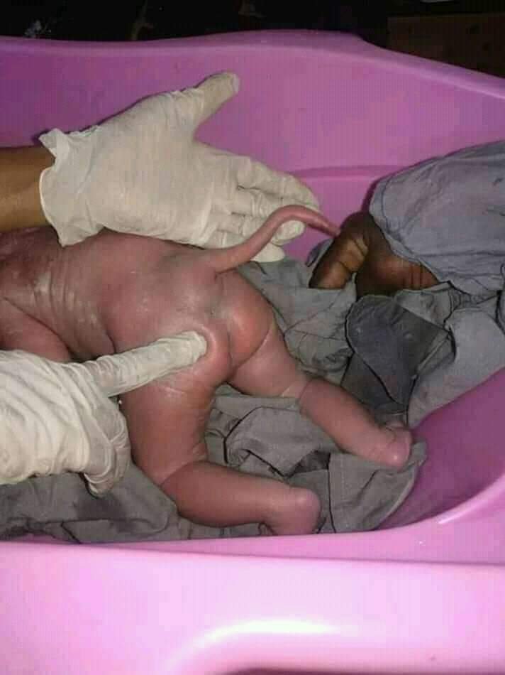 FAKE – Imagem de menino que nasceu com rabo em Santarem viralizaram