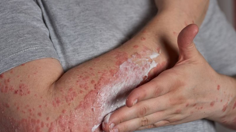 Surto de catapora deixa cerca de 500 alunos sem aula na escola municipal